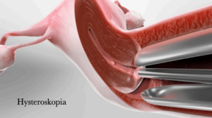 hysteroskopia